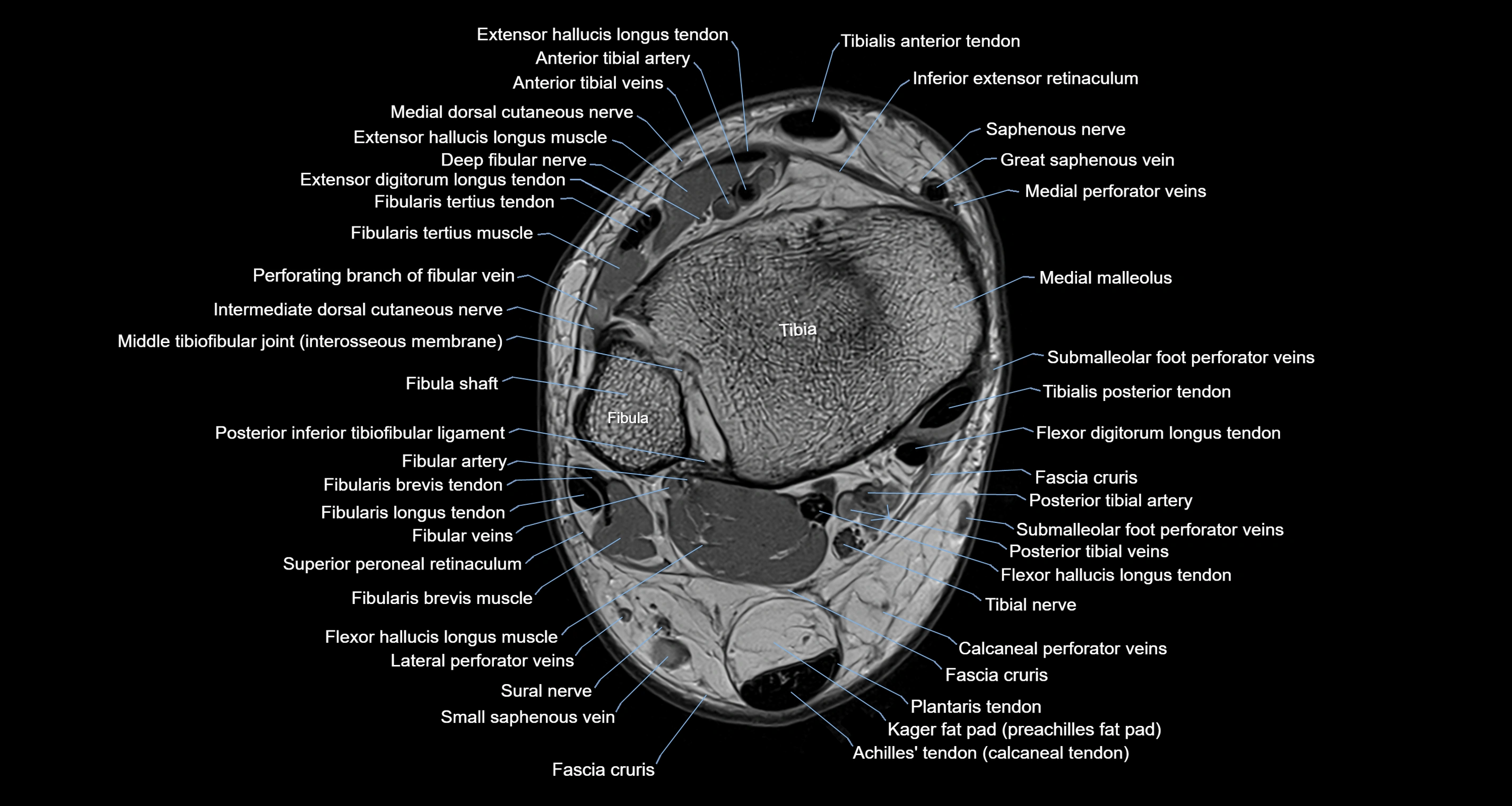 Ankle axial anatomy 3T MRI images -img-10001-00010.webp